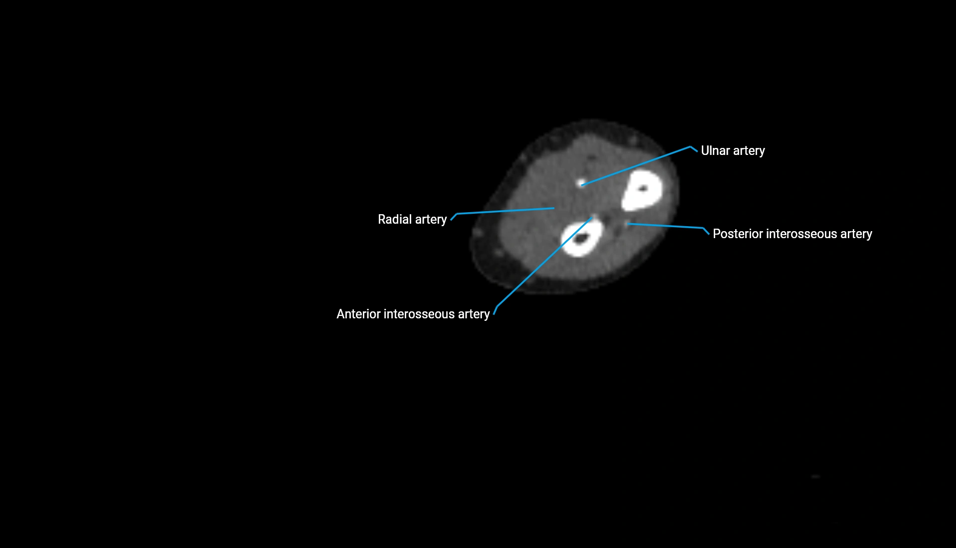 CTA upper limb axial cross sectional anatomy labelled image 152 (2).webp
